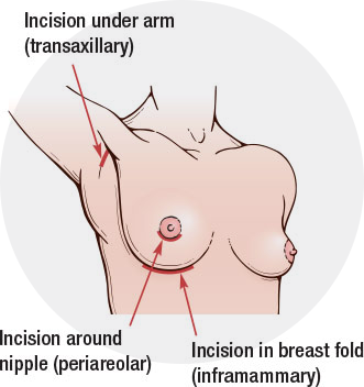 Everything You Need to Know About Natrelle Implants, BPS