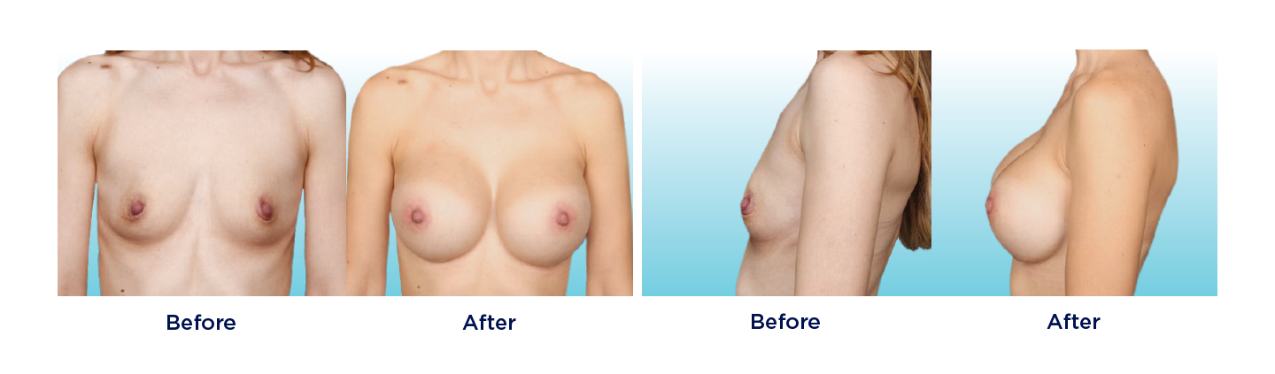 Breast Reconstruction, Natrelle® Gummy Implants